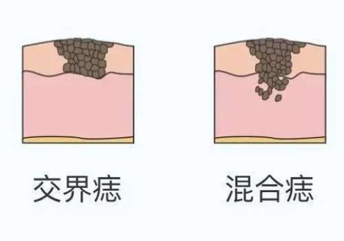 吴信峰切痣效果真实评价！缝合精细、看不出疤痕插图3