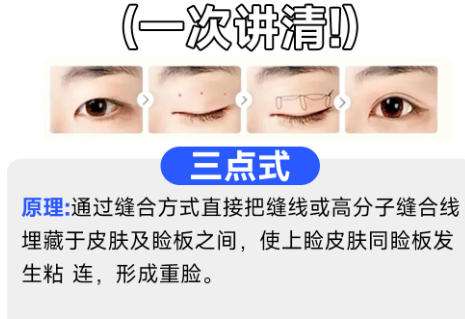 金石峰双眼皮效果图片揭示！含医生详细介绍及真实口碑点评插图2