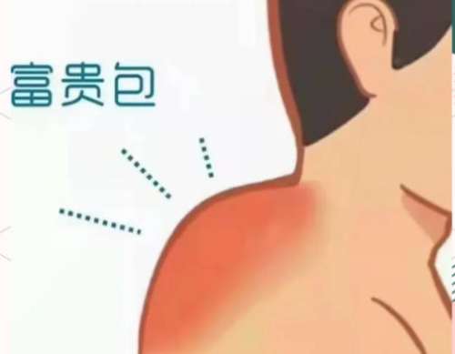 闫存礼医生富贵包手术评价咋样？宝鸡妇幼“精准抽吸技术派”，网友反馈：术后第二天就出院！插图