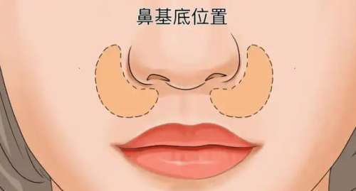 合肥艺星玻尿酸鼻基底填充价格贵吗?参考范围3923~18,097元左右!插图3 合肥艺星玻尿酸鼻基底填充价格贵吗?参考范围3923~18,097元左右!插图3