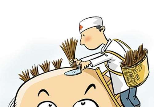 漳州市医院植发多少钱?1万元起,发际线调整到头顶加密技术强插图3 漳州市医院植发多少钱?1万元起,发际线调整到头顶加密技术强插图3