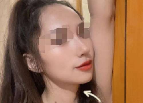成都蔡震做鼻子怎么样?医生技术点评+隆鼻案例分享插图2 成都蔡震做鼻子怎么样?医生技术点评+隆鼻案例分享插图2