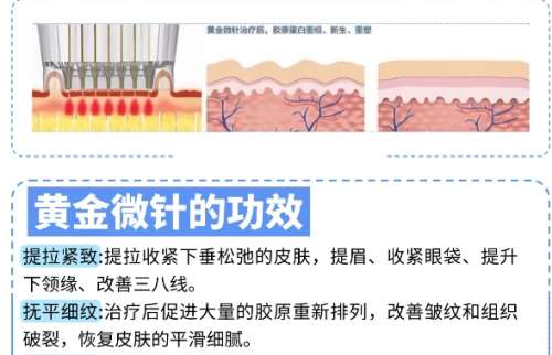 西南医院黄金微针价格表参考！院内皮肤技术优势分析！插图1