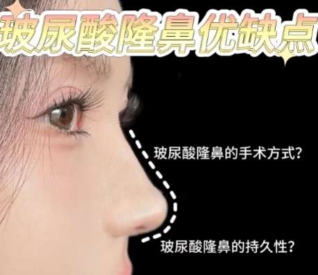 成都娇点注射隆鼻多少钱?2026收费标准更新!插图1 成都娇点注射隆鼻多少钱?2026收费标准更新!插图1