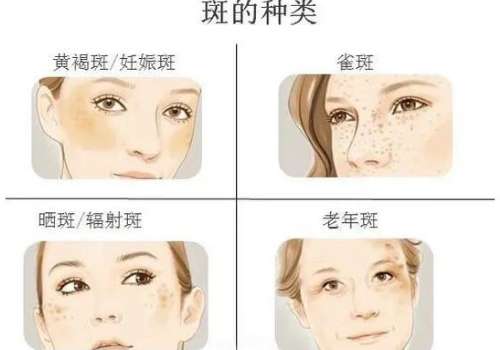 上海九医院祛斑怎么收费的?2k元起,价格透明+真人案例展示插图4 上海九医院祛斑怎么收费的?2k元起,价格透明+真人案例展示插图4