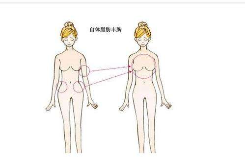 重庆章小平脂肪隆胸怎么样?军美胸部整形全能专家，价格3万-4万元起插图