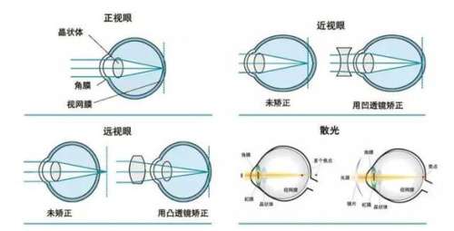成都三医院近视手术价格26年揭秘,全飞秒1.6万-2.5万元起,晶体3万起插图 成都三医院近视手术价格26年揭秘,全飞秒1.6万-2.5万元起,晶体3万起插图