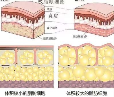 刘纬驰医生吸脂的口碑怎么样？真实水平揭秘！含案例插图4