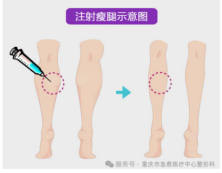 注射瘦腿效果怎么样？吸脂多久才能恢复自然插图