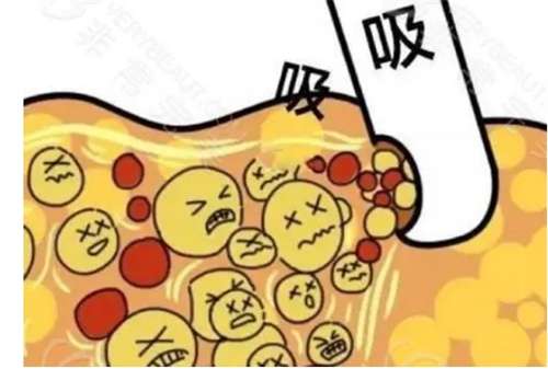 重庆吸脂价格贵不贵？在线评估吸脂价格插图3
