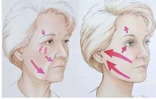 杭州拉皮多少钱?拉皮术后怎么护理,专家讲解插图1 杭州拉皮多少钱?拉皮术后怎么护理,专家讲解插图1