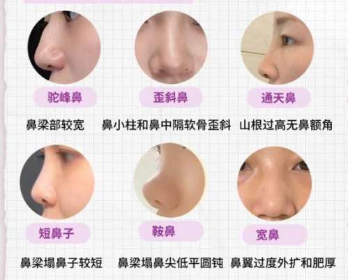 沈阳车金昊隆鼻怎么样?医生实力点评!含价格插图3 沈阳车金昊隆鼻怎么样?医生实力点评!含价格插图3