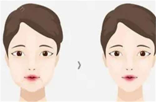 下颌角磨骨整形手术多少钱？多久能恢复？插图1