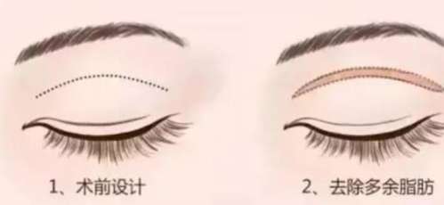 南京鼓楼医院燕辛医生双眼皮案例曝光|戳进来看真人蜕变之旅!插图2 南京鼓楼医院燕辛医生双眼皮案例曝光|戳进来看真人蜕变之旅!插图2