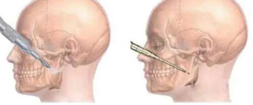 颌骨矫正手术需要多少钱插图2
