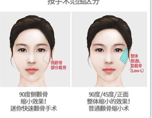 颧骨整形多少钱?价格明细公布,2026年新公布插图1 颧骨整形多少钱?价格明细公布,2026年新公布插图1