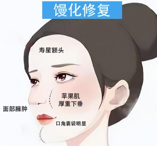 北京馒化脸修复价格多少钱?北京地区面部美容修复手术费用指南插图1 北京馒化脸修复价格多少钱?北京地区面部美容修复手术费用指南插图1
