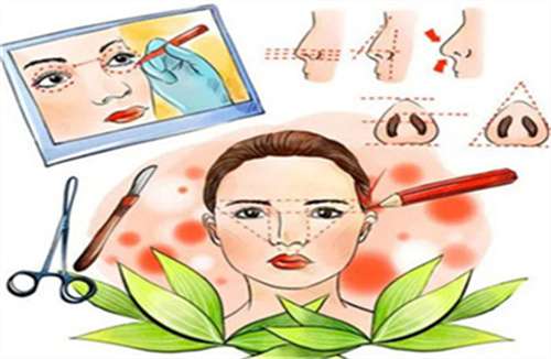 自体软骨隆鼻多少钱？维持时间多久？一文概括插图3