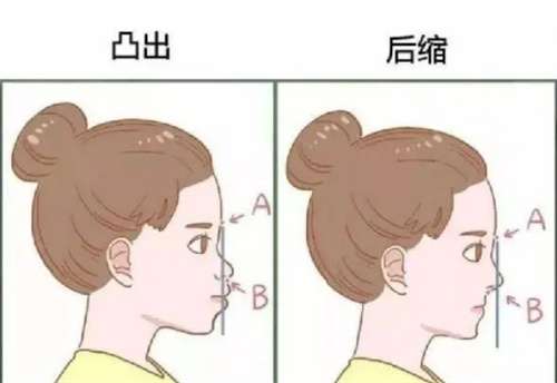 正颌一般多少钱?正颌年龄介绍,术前解析插图1 正颌一般多少钱?正颌年龄介绍,术前解析插图1