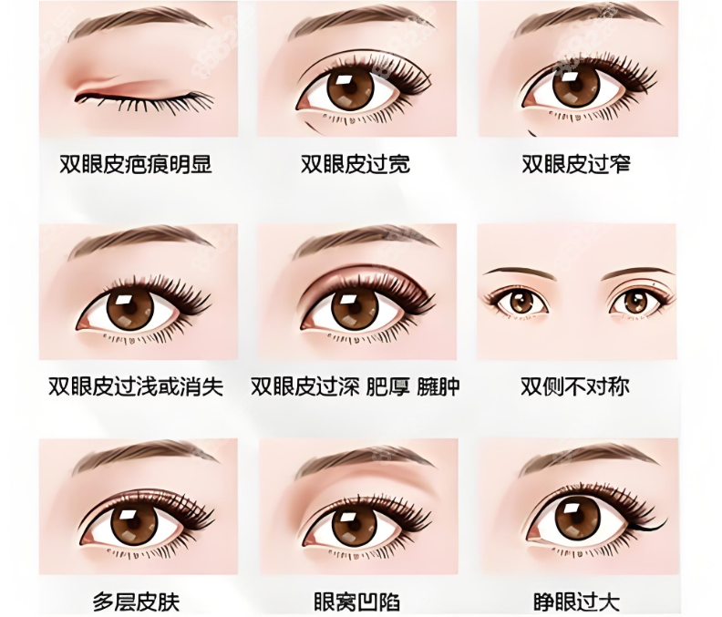 北京哪家医院双眼皮手术做得好?北京双眼皮整形医院推荐插图4 北京哪家医院双眼皮手术做得好?北京双眼皮整形医院推荐插图4