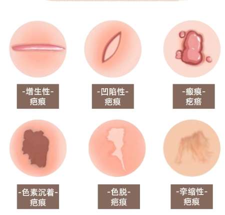 刘晓军医生口碑怎么样?瘢痕修复-南方医科大学南方医院插图4 刘晓军医生口碑怎么样?瘢痕修复-南方医科大学南方医院插图4