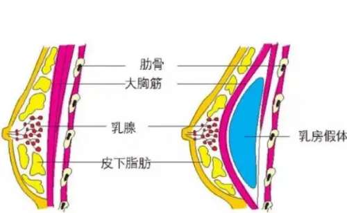 八大处整形医院假体隆胸案例分享|技术能力怎么样?报价多少插图2 八大处整形医院假体隆胸案例分享|技术能力怎么样?报价多少插图2