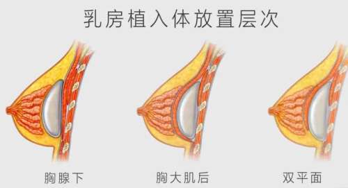深圳北大医院假体隆胸费用贵不贵?胸部整形项目记录贴分享插图4 深圳北大医院假体隆胸费用贵不贵?胸部整形项目记录贴分享插图4