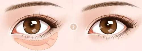 长沙去眼袋一般多少钱？一般在3000-7800元插图1