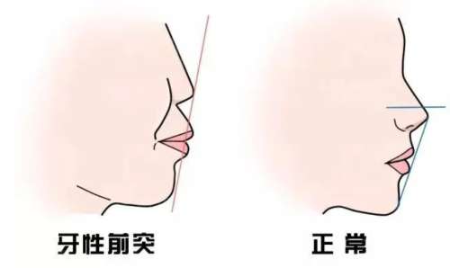 矫正嘴凸大概要多少钱?一般是在6000元到3万元插图1 矫正嘴凸大概要多少钱?一般是在6000元到3万元插图1