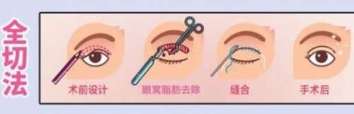 湖南省人民医院李波双眼皮价格是多少？全切、埋线费用区别较大！插图1