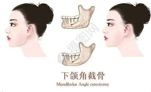 下颌角整形多少钱?看收费详情,做好攻略插图3 下颌角整形多少钱?看收费详情,做好攻略插图3