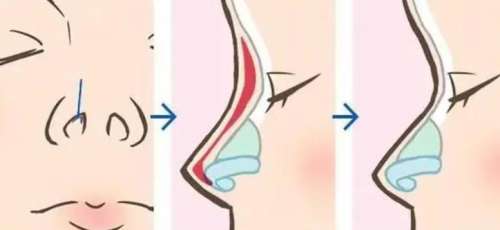 天津假体隆鼻的费用多少钱?一般在10000-50000元,附案例插图1 天津假体隆鼻的费用多少钱?一般在10000-50000元,附案例插图1