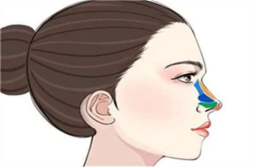 硅胶隆鼻多少钱?硅胶隆鼻多久能恢复?点击了解插图2 硅胶隆鼻多少钱?硅胶隆鼻多久能恢复?点击了解插图2