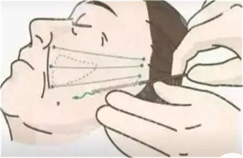 小拉皮手术多少钱一次?赶走皱纹,恢复注意事项公布插图2 小拉皮手术多少钱一次?赶走皱纹,恢复注意事项公布插图2