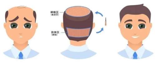 *痕植发多少钱一根插图1 *痕植发多少钱一根插图1