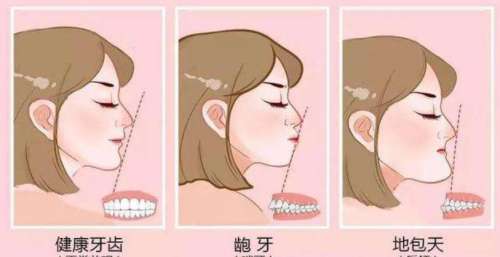 北京地包天矫正需要多少费用?价格通常是12w到15w不等插图 北京地包天矫正需要多少费用?价格通常是12w到15w不等插图