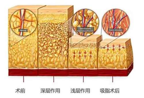 激光溶脂瘦脸多少钱?价格大概在3千到6千元插图1 激光溶脂瘦脸多少钱?价格大概在3千到6千元插图1