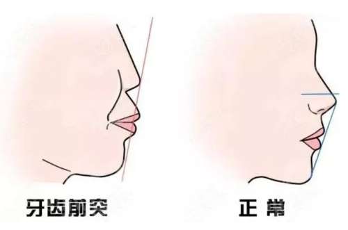 上骨突出矫正一般要多少钱?一般是在2万元到8万元之间插图1 上骨突出矫正一般要多少钱?一般是在2万元到8万元之间插图1