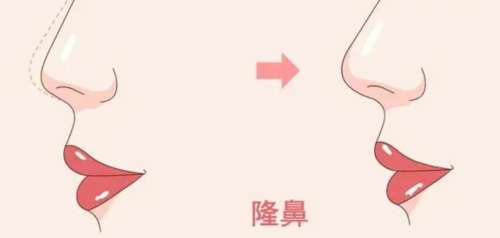 北京做肋骨鼻部综合多少钱?在24313元至76531元之间插图 北京做肋骨鼻部综合多少钱?在24313元至76531元之间插图