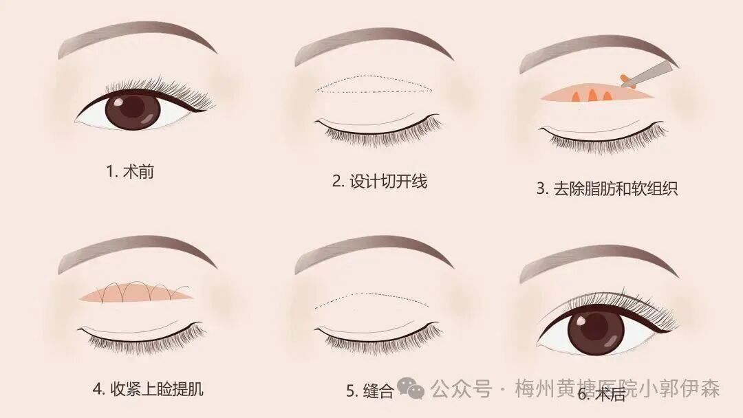 长沙全切双眼皮价格全攻略:多少钱才不亏?插图 长沙全切双眼皮价格全攻略:多少钱才不亏?插图