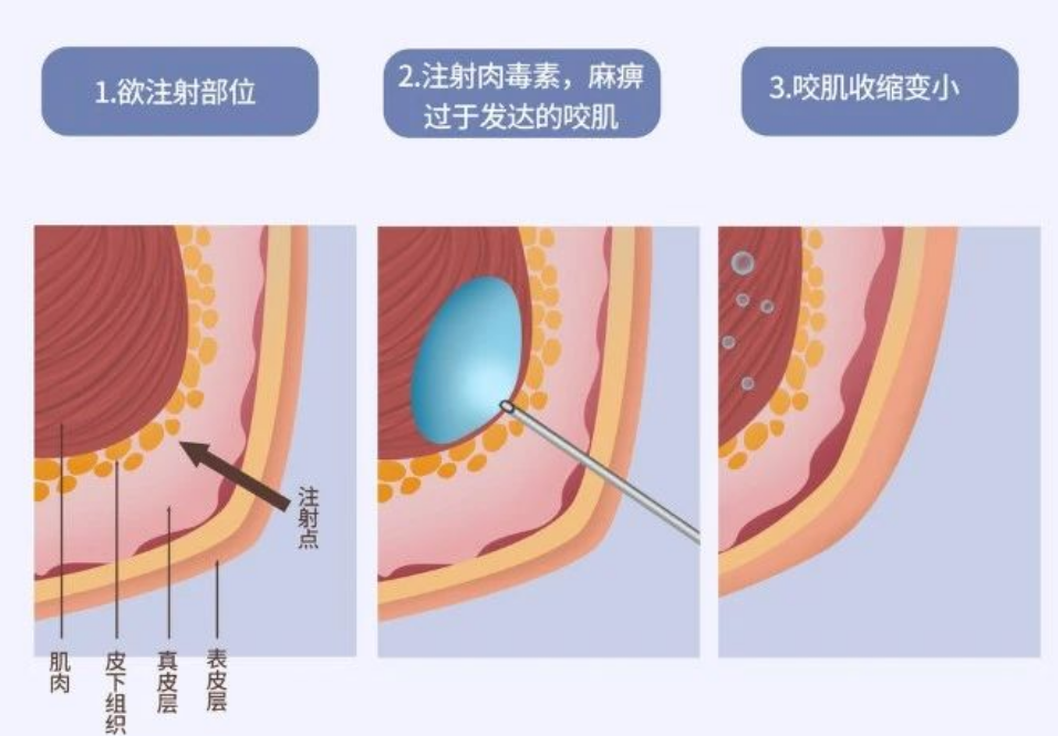 长沙打瘦脸针去哪家医院好?本地人推荐这几家插图1 长沙打瘦脸针去哪家医院好?本地人推荐这几家插图1