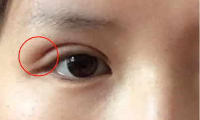 广州做双眼皮失败修复,哪几位专家技术最稳?插图 广州做双眼皮失败修复,哪几位专家技术最稳?插图
