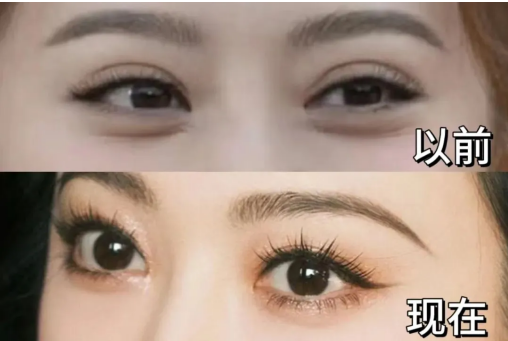 广州做双眼皮失败修复,哪几位专家技术最稳?插图1 广州做双眼皮失败修复,哪几位专家技术最稳?插图1