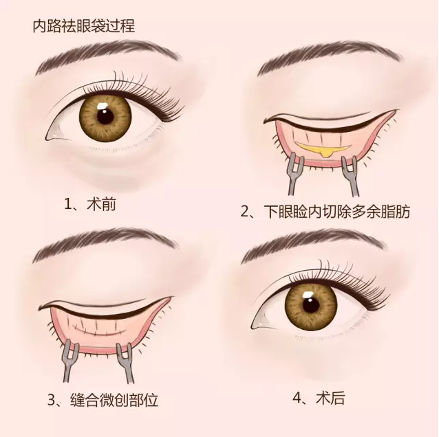眼袋手术选内切还是外切?医生大实话告诉你真相插图 眼袋手术选内切还是外切?医生大实话告诉你真相插图