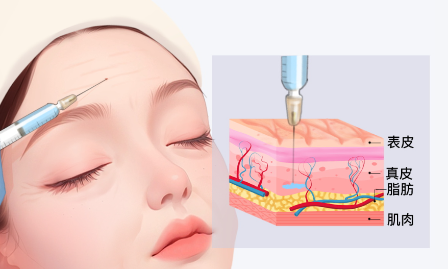玻尿酸打一次能管多久 代谢完要花多少时间插图 玻尿酸打一次能管多久 代谢完要花多少时间插图