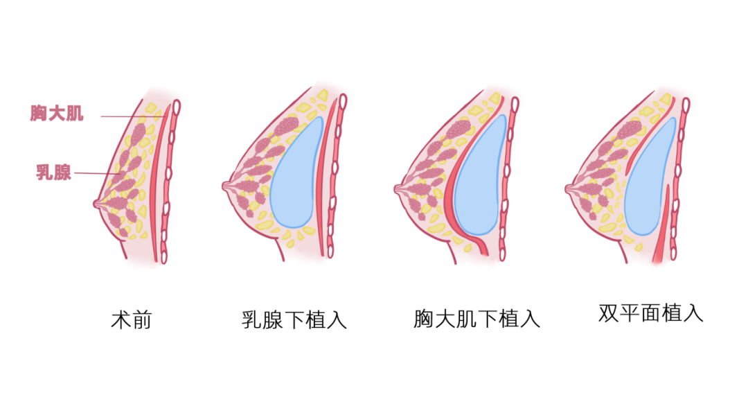 假体和自体脂肪隆胸哪个好?别再瞎纠结了,选错毁一生!插图1 假体和自体脂肪隆胸哪个好?别再瞎纠结了,选错毁一生!插图1