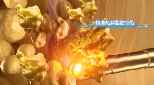 广州做黄金微雕吸脂到底要多少钱?插图1 广州做黄金微雕吸脂到底要多少钱?插图1