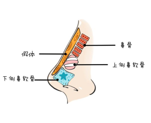 隆鼻假体取出费用详解 | 了解隆鼻假体取出手术的具体价格及注意事项插图 隆鼻假体取出费用详解 | 了解隆鼻假体取出手术的具体价格及注意事项插图
