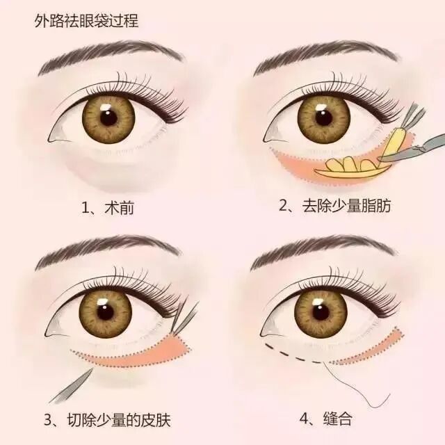 眼袋手术选内切还是外切?医生大实话告诉你真相插图1 眼袋手术选内切还是外切?医生大实话告诉你真相插图1