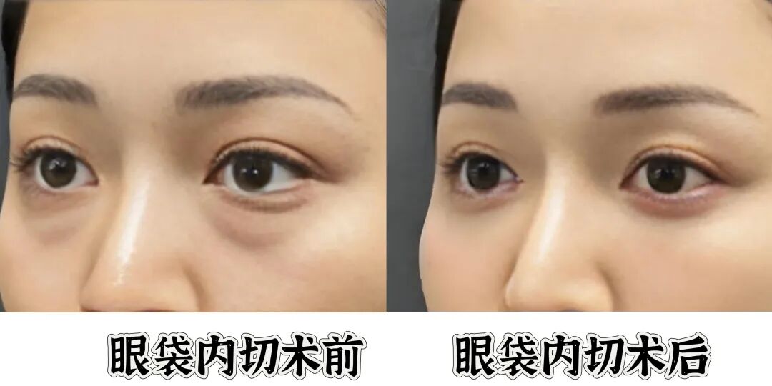 眼袋手术选内切还是外切?医生大实话告诉你真相插图2 眼袋手术选内切还是外切?医生大实话告诉你真相插图2